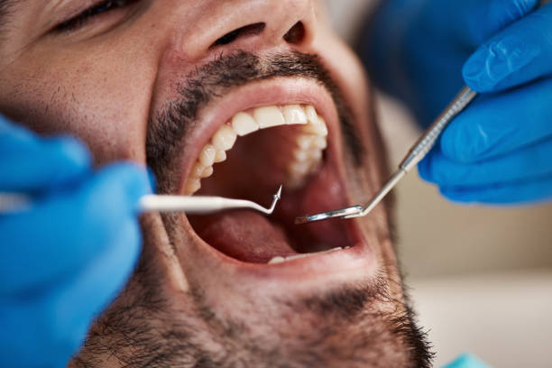 Best Knocked-Out Tooth (Avulsed Tooth) Treatment in Port Vue, PA